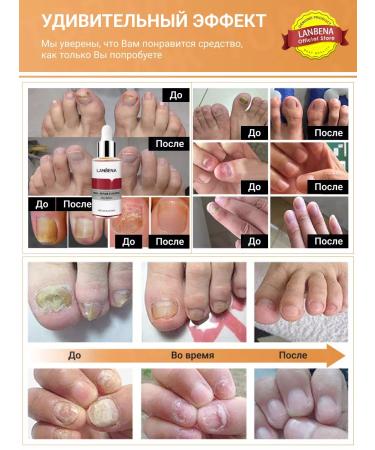 LANBENA Remedy for the nail fungus onholysis - Buy Online on GoSupps.com