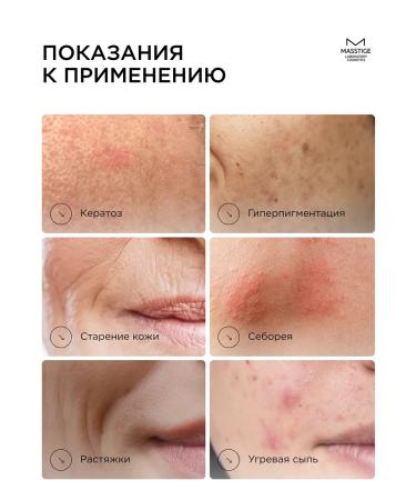 MASSTIGE Piling Tonik for Facial Acids 200ml - Buy Online on GoSupps.com