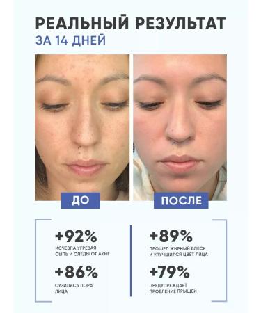 EWAM Acne serum and face acne - Buy Online on GoSupps.com