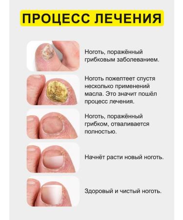 SilaVeRes Antifungal tool for the nails onholysis 2x5 ml - Buy Online on GoSupps.com