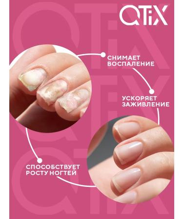 QTiX Casting serum onicholysis for nail recovery - Buy Online on GoSupps.com
