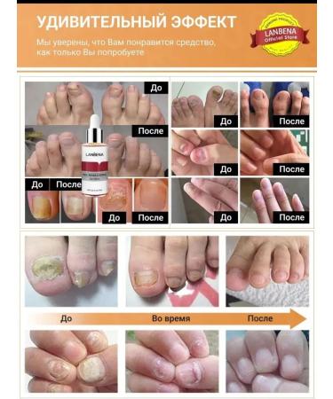 Cosmobrend Essence from nail fungus - Buy Online on GoSupps.com