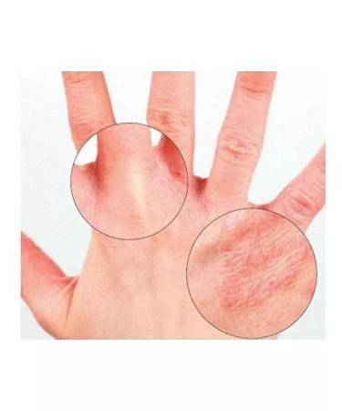 House of Health Cream from psoriasis Zudaifu 15 ml - Buy Online on GoSupps.com