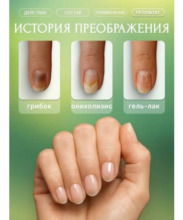 Springs of Siberia Monarchy oil is therapeutic from onycholysis and fungus - Buy Online on GoSupps.com