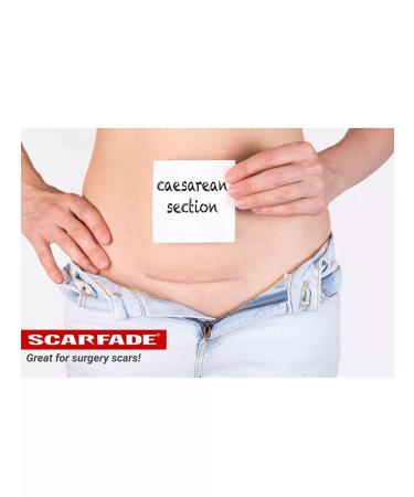 Hanson Skincare Scarfade Elite Extended Treatment of Scars - 15g - Buy Online on GoSupps.com