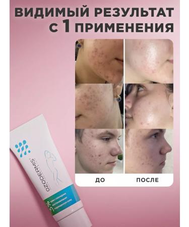 OzoneBox Ozodermis 3% cream from acne post -acne and rosacea - Buy Online on GoSupps.com