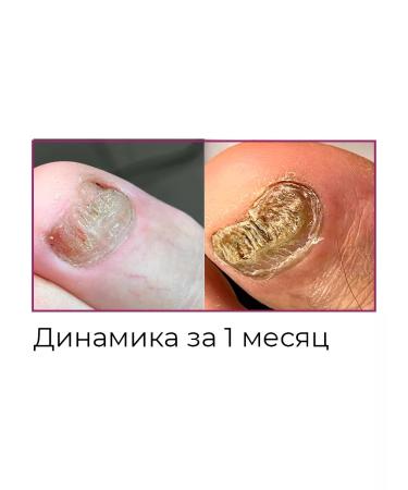 ROSILAK Professional set for the treatment and restoration of nails - Buy Online on GoSupps.com