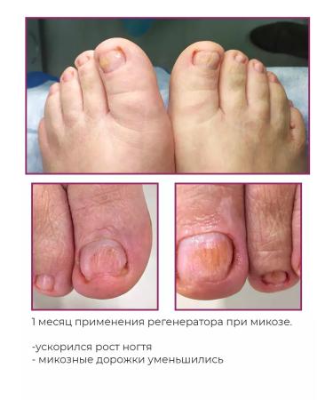 ROSILAK Professional set for the treatment and restoration of nails - Buy Online on GoSupps.com