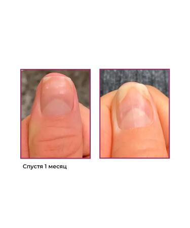 ROSILAK Professional set for the treatment and restoration of nails - Buy Online on GoSupps.com