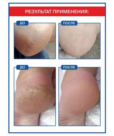 NANO-HEELS Set for pedicure and wax for heels - Buy Online on GoSupps.com