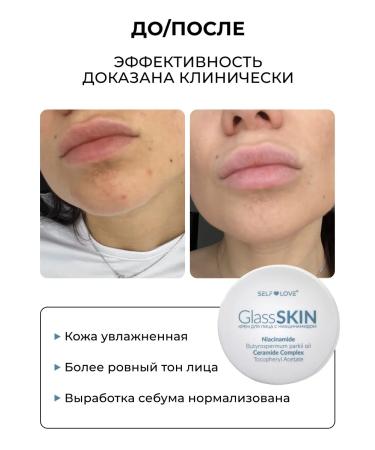 SelfLoveMedical Facial cream for acne with niacinamide - Buy Online on GoSupps.com
