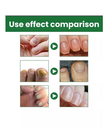 Dima shop Remedy for nail fungus on the legs cream - Buy Online on GoSupps.com