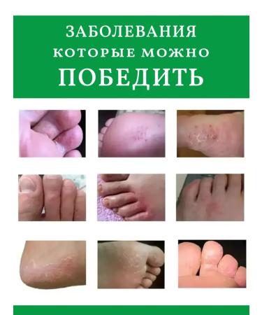 ZaKrasoty Remedy for nail fungus and mycose set - Buy Online on GoSupps.com