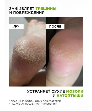 MIXIT Keratolytic for heels against corns and corns 2 pcs - Buy Online on GoSupps.com