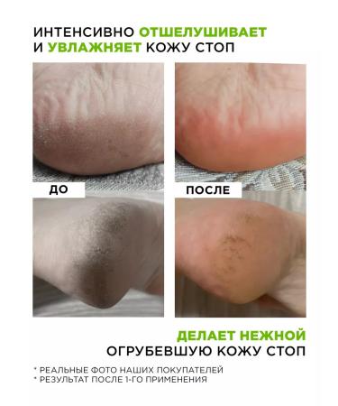 MIXIT Keratolytic for heels against corns and corns 2 pcs - Buy Online on GoSupps.com