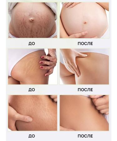 PrettyGirl Moisturizing Stretch Mark Cream for Pregnant Women 50g - Buy Online on GoSupps.com