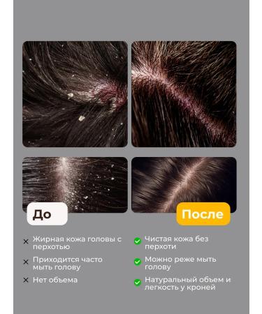 JoceJoli Remed for dandruff - Buy Online on GoSupps.com