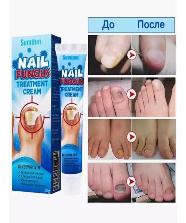 Tovus Beauty Anti-nail fungus cream - Buy Online on GoSupps.com