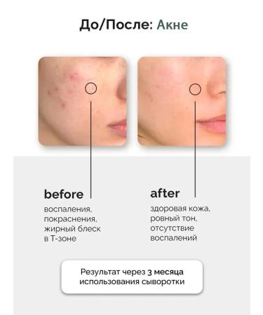 Anua Facial serum from rashes 30 ml - Buy Online on GoSupps.com