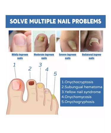 Chinese remedy for fungus Chinese remedy for nail fungus 20 g - Buy Online on GoSupps.com
