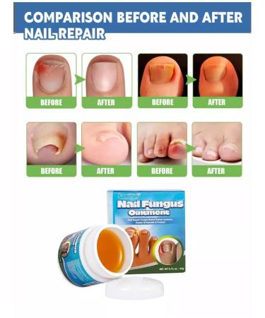 Chinese remedy for fungus Chinese remedy for nail fungus 20 g - Buy Online on GoSupps.com