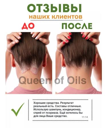 Queen of Oils Set of shampoo and balm from psoriasis and seborrhea - Buy Online on GoSupps.com