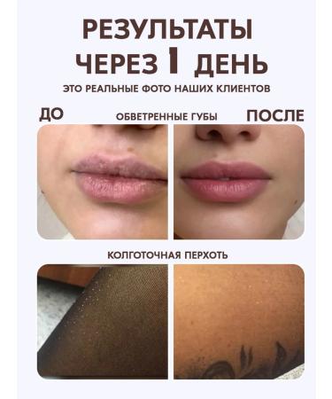 Bonimed Cream of wax from cracks with urea 10% set - Buy Online on GoSupps.com