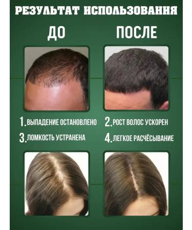 Alexirm Lotion for hair growth of beard and eyebrows 3 pcs. + Gift - Buy Online on GoSupps.com