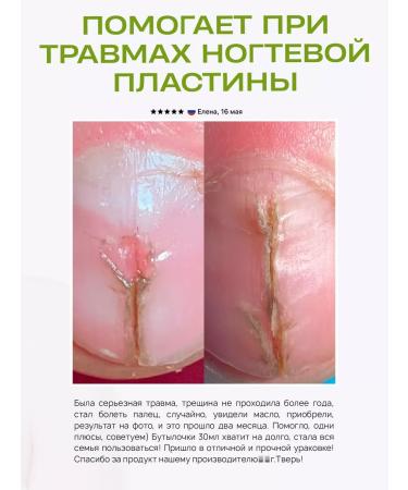 Lengraise CO2 monard oil for nails from onycholysis (30ml + 30ml) - Buy Online on GoSupps.com