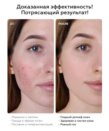 BIOBALANCE Serum - face peeling exfoliating against acne - Buy Online on GoSupps.com