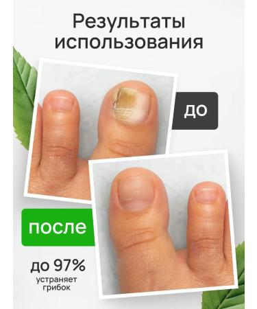 Lokopro Hero for nails of stop onycholisis restoring - Buy Online on GoSupps.com