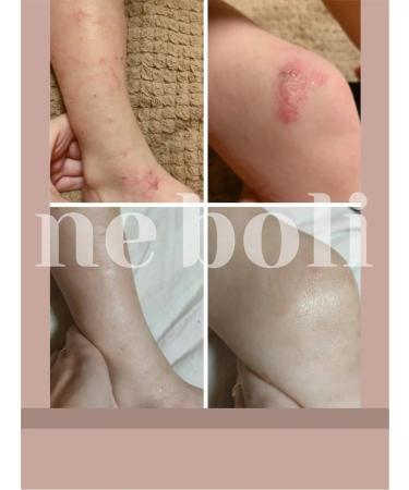 NeBoli Atopic allergic dermatitis 30ml - Buy Online on GoSupps.com