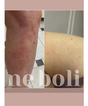 NeBoli Atopic allergic dermatitis 30ml - Buy Online on GoSupps.com