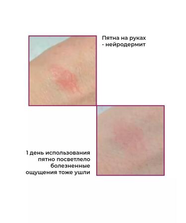 Rosilak A set of tools for problematic and sensitive skin - Buy Online on GoSupps.com