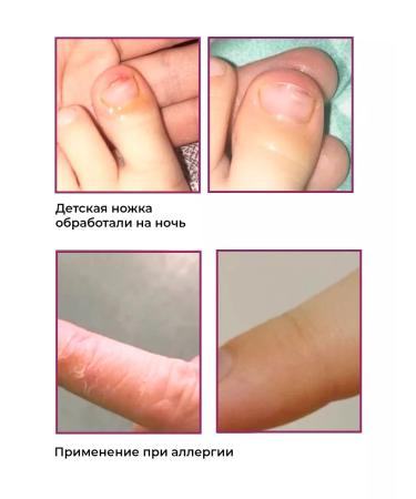 Rosilak A set of tools for problematic and sensitive skin - Buy Online on GoSupps.com