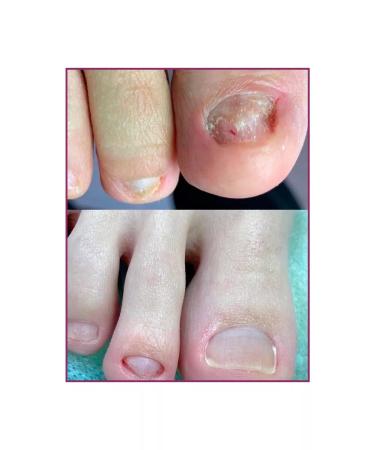 Odiva Nail growth regenerator and oncholysis laser saw - Buy Online on GoSupps.com