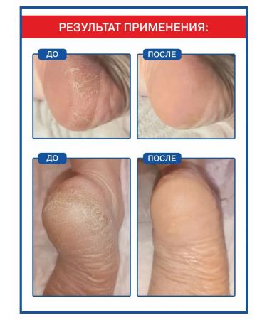 NANO-HEELS Heel care - Buy Online on GoSupps.com