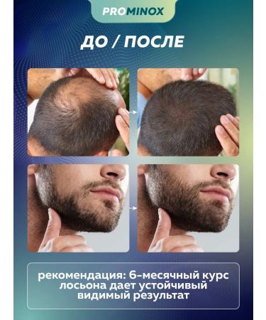 PROMINOX Hair and beard growth 60 ml 15% - Buy Online on GoSupps.com