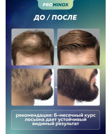 PROMINOX Hair and beard growth 60 ml 15% - Buy Online on GoSupps.com