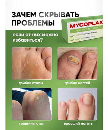 Althea Remedy for nail fungus and legs Mycoplax mycoplas - Buy Online on GoSupps.com