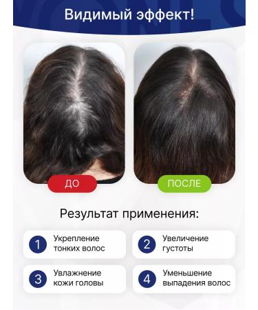 Yones Professional Hair growth serum - Buy Online on GoSupps.com
