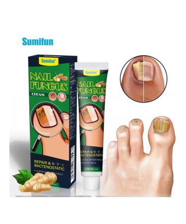 KOREA ORIGINAL Cream from nail fungus and skin antiseptic