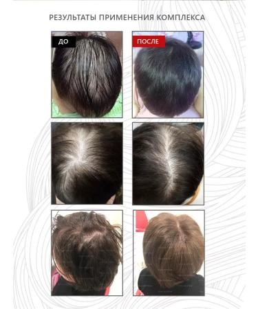 FOLLISYSTEM Complex for hair growth against falling out - FS - Buy Online on GoSupps.com