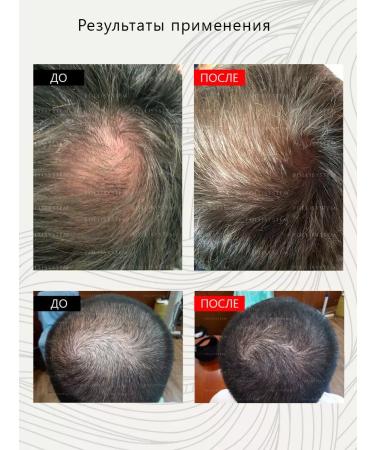 FOLLISYSTEM Serum against loss and for hair growth fs1 30 ml - Buy Online on GoSupps.com