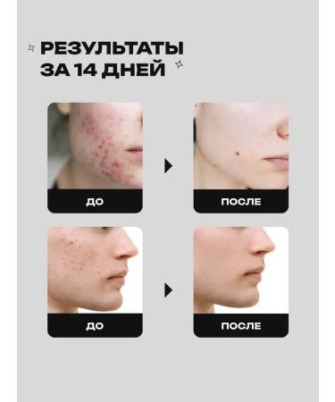 lvcos Acne cream serum - Buy Online on GoSupps.com