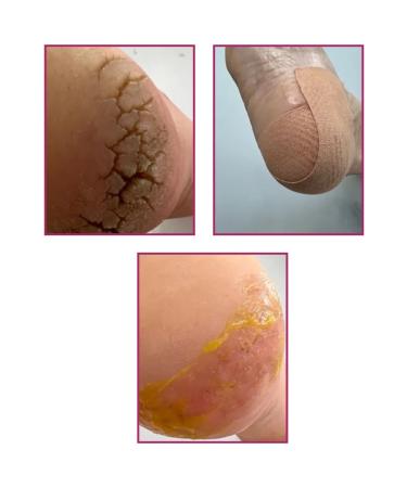 ROSILAK Cream for legs moisturizer cream mask with cracks on heels - Buy Online on GoSupps.com