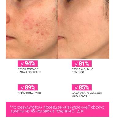 ETU Acne face serum - Buy Online on GoSupps.com