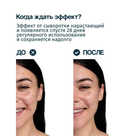 ZENZE Facial serum from acne and acne with niacinamide 15% - Buy Online on GoSupps.com