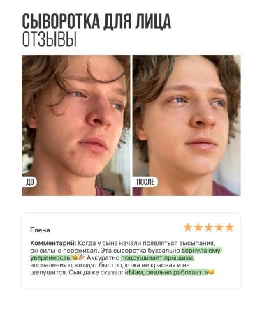 7DAYS Facial serum from acne with niacinamide 60ml - Buy Online on GoSupps.com