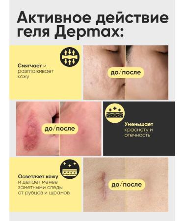 balace Dermax Neo Cream from scars and scars from stretch marks - Buy Online on GoSupps.com